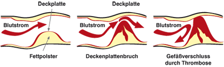 Entstehung Arteriosklerose (Arterienverkalkung/ Arterienverhärtung) Entstehung Arteriosklerose (Arterienverkalkung/ Arterienverhärtung)